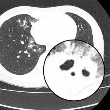 突然中招!30岁女子咳一周查出肺里好多洞!这类人尤其注意,早期无症状…… 突然中招!30岁女子咳一周查出肺里好多洞!这类人尤其注意,早期无症状……