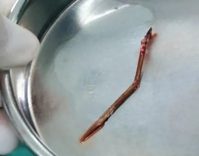 久治不愈！男子剔牙误将牙签吸入肺中感染肺炎，医生提醒：严重可危及生命