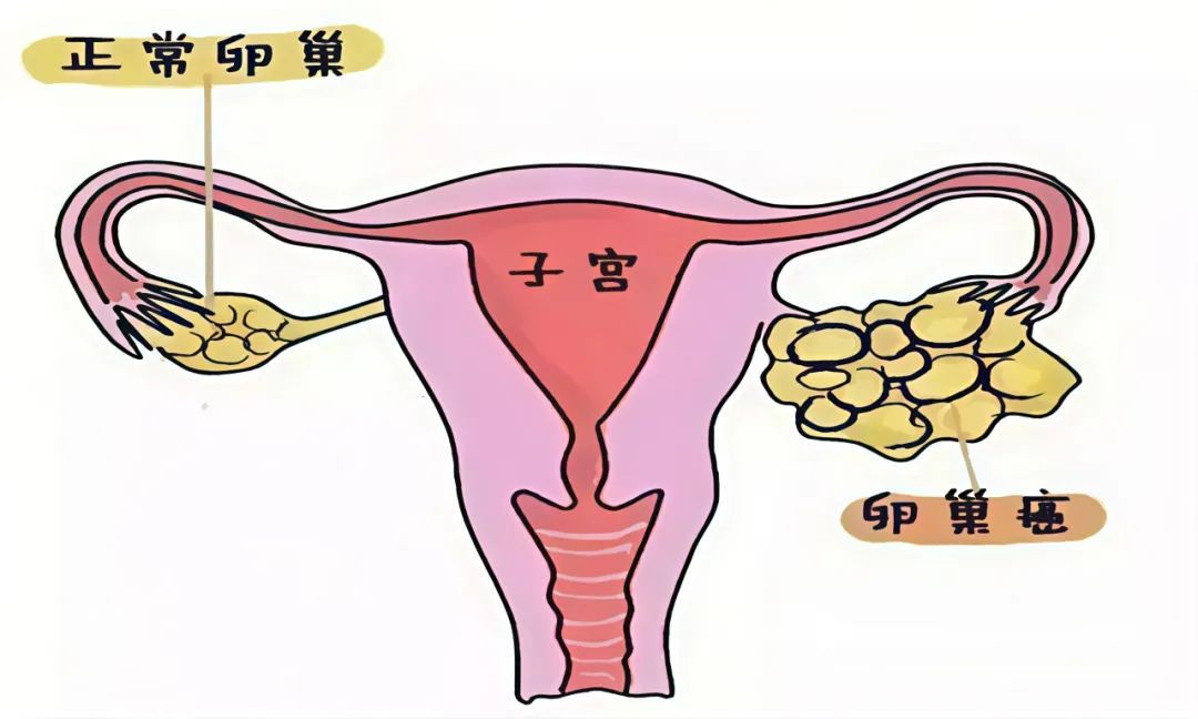 70%患者发现时已是晚期，警惕“沉默”的卵巢癌