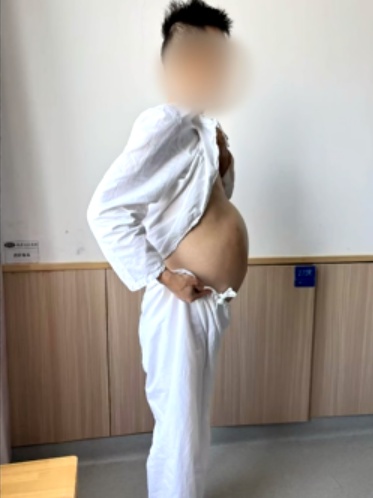 男子4个月没大便，医生手术取出2米长“蟒蛇肠”！