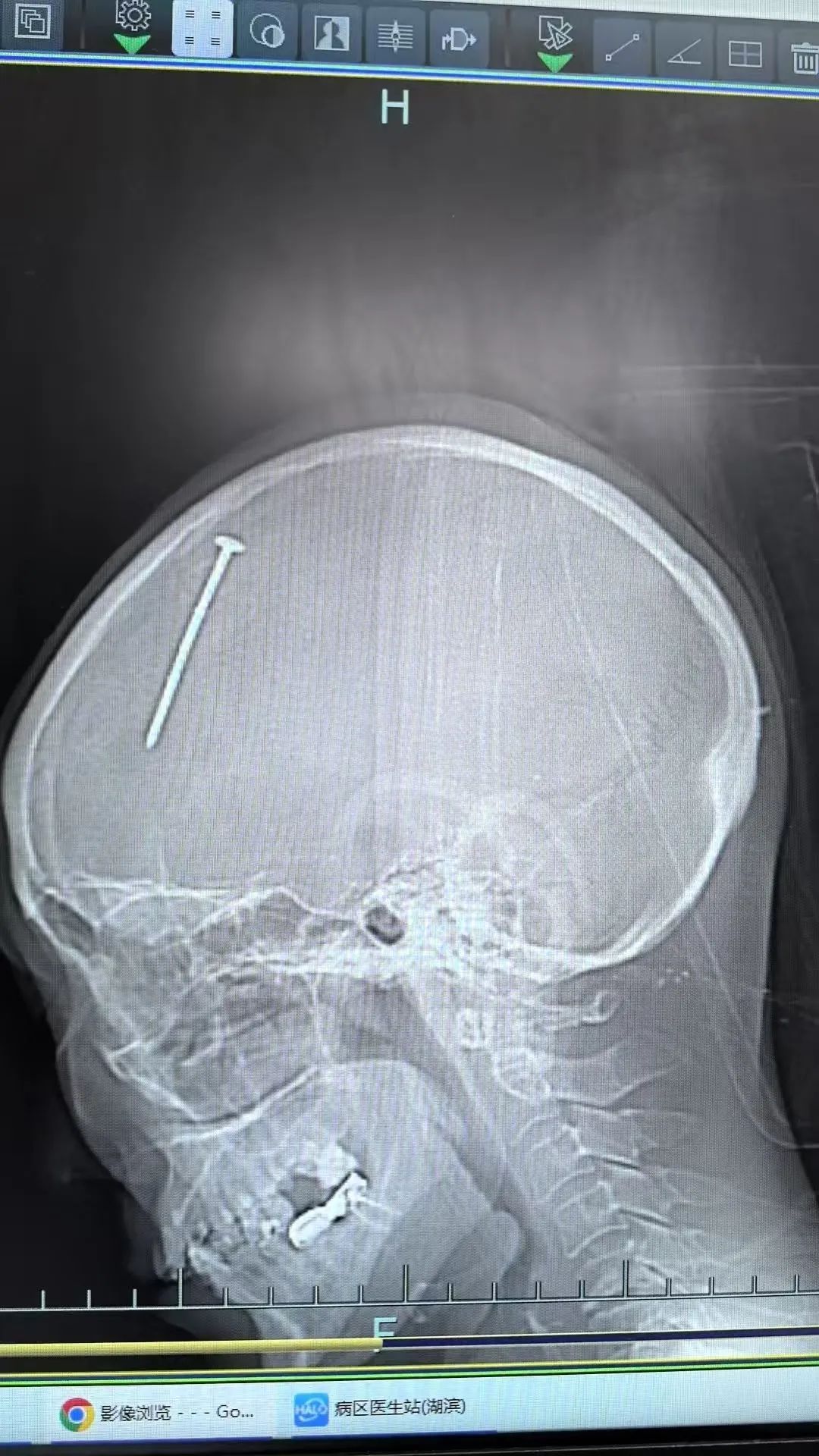 6cm铁钉直插女子颅内!复查CT后,医生被惊呆了:这种情况太罕见 6cm铁钉直插女子颅内!复查CT后,医生被惊呆了:这种情况太罕见