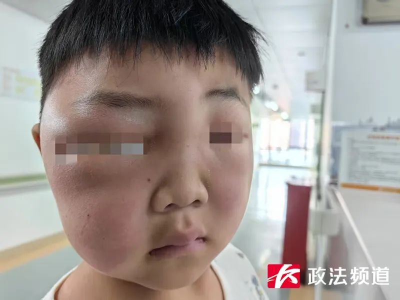 孩子一觉醒来，爹妈傻眼了！长沙一家医院近期收治多例，医生提醒→