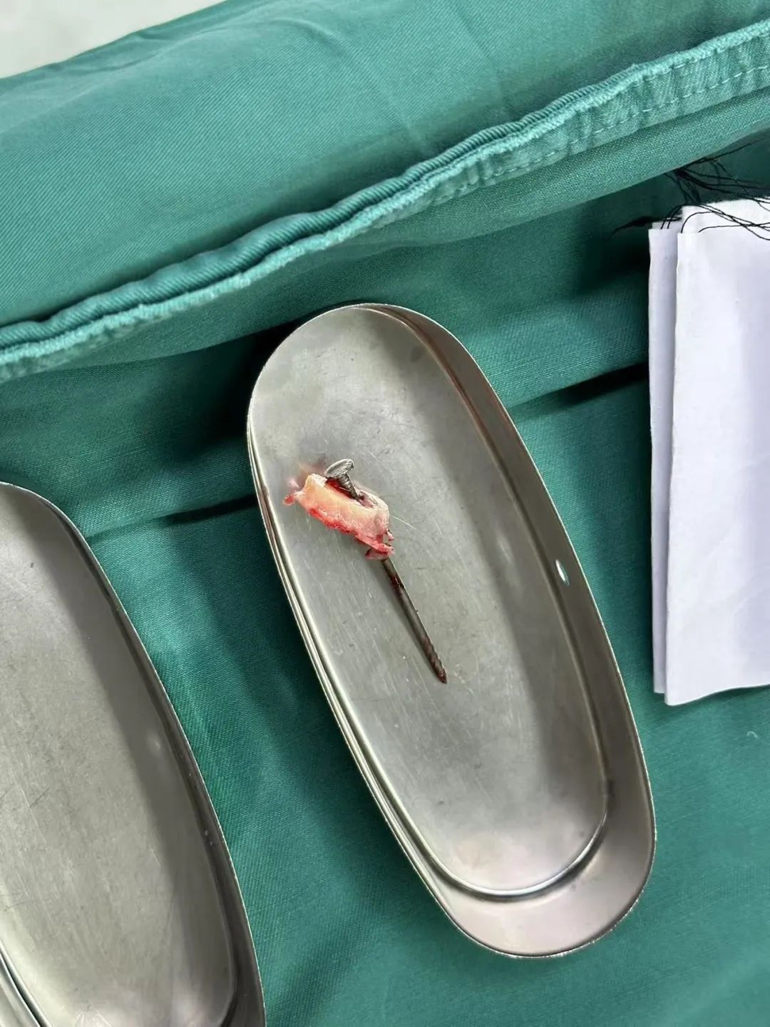 6cm铁钉直插女子颅内!复查CT后,医生被惊呆了:这种情况太罕见 6cm铁钉直插女子颅内!复查CT后,医生被惊呆了:这种情况太罕见