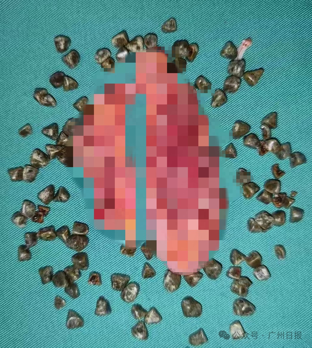 密密麻麻！女子体内查出近百颗……医生都震惊了！