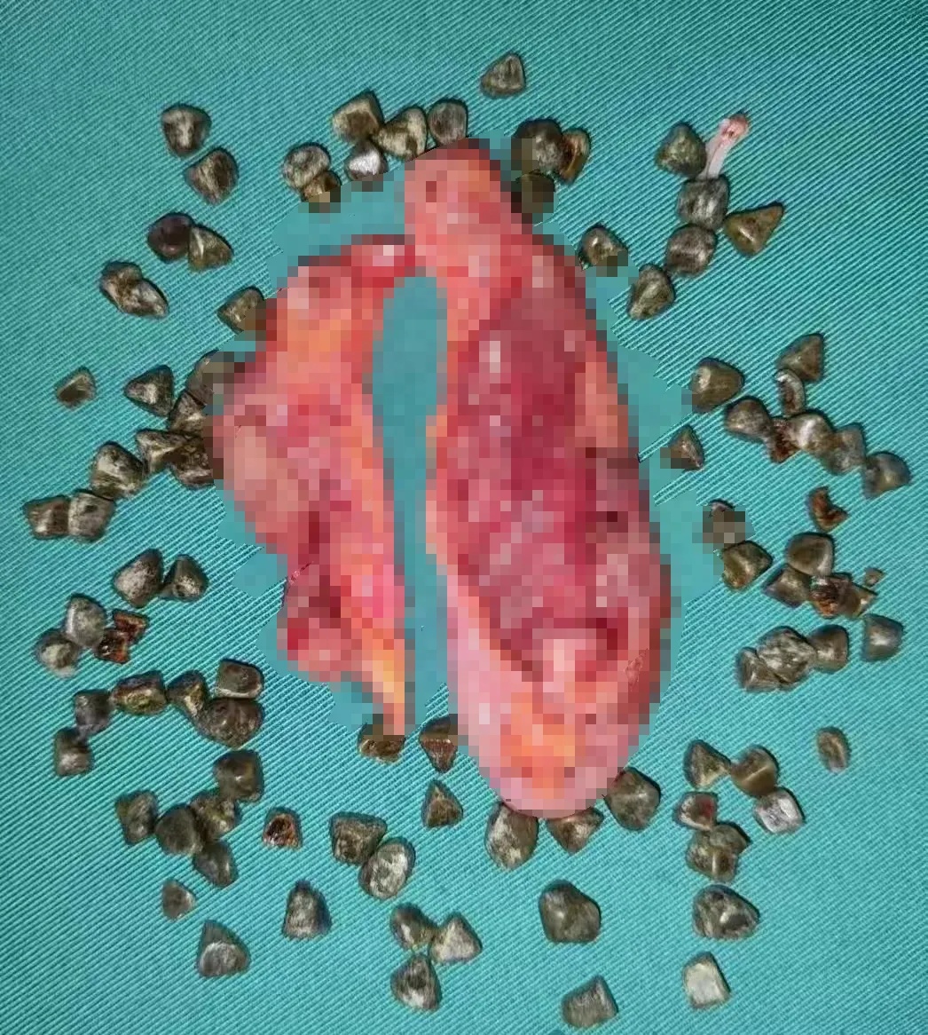 “就像开盲盒开到水晶矿洞！”女子体内长了上百颗！这个习惯很多人都有