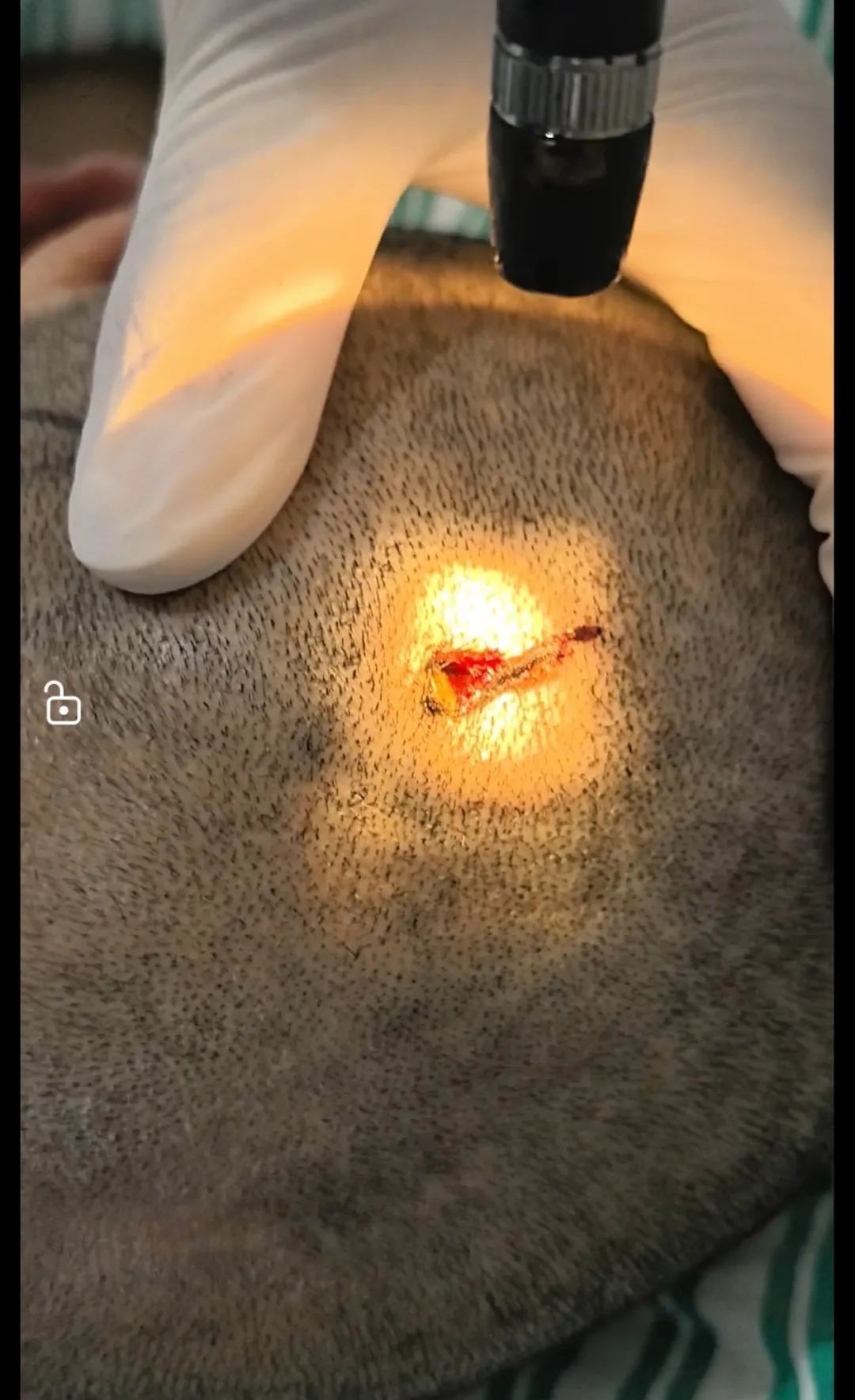 6cm铁钉直插女子颅内!复查CT后,医生被惊呆了:这种情况太罕见 6cm铁钉直插女子颅内!复查CT后,医生被惊呆了:这种情况太罕见