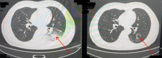有人直接“白肺”!近期几乎家家在用,这个细节容易被忽视 有人直接“白肺”!近期几乎家家在用,这个细节容易被忽视