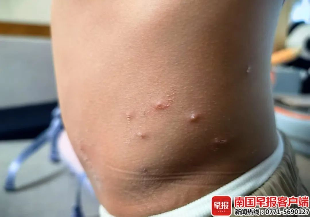 南宁一小区多人被跳蚤叮咬！一名养猫业主写了道歉信