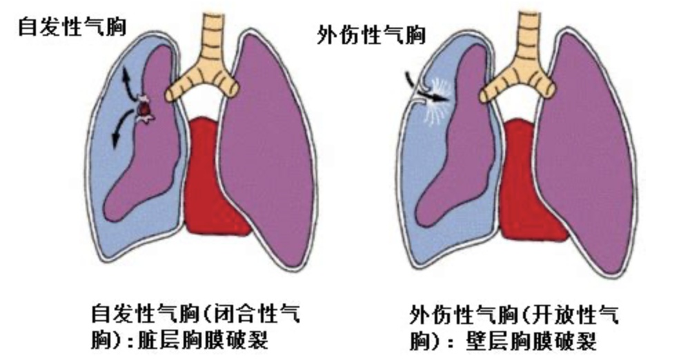 “气胸”到底是啥病?不仅选男女?还挑身材?这类人警惕→ “气胸”到底是啥病?不仅选男女?还挑身材?这类人警惕→
