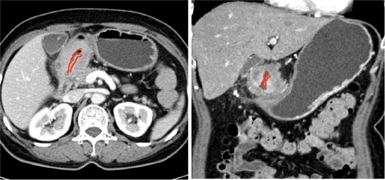 男子胃口变差,吃了就想吐……查出即晚期!这种癌要靠这样发现 男子胃口变差,吃了就想吐……查出即晚期!这种癌要靠这样发现