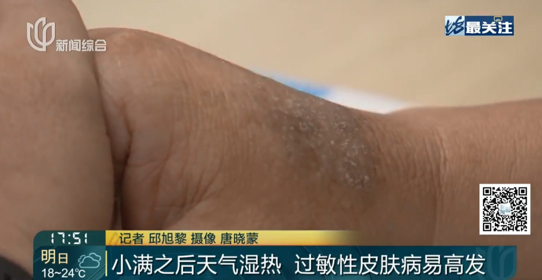 整晚睡不着! 沪一女子身上成片出现…近期高发,紧急提醒 整晚睡不着! 沪一女子身上成片出现…近期高发,紧急提醒