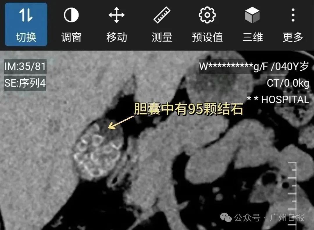 长期不吃早饭、经常吃宵夜,福建一女子体内查出95颗结石! 长期不吃早饭、经常吃宵夜,福建一女子体内查出95颗结石!