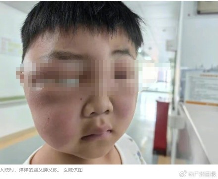 4岁男孩睡觉被虫咬了一口，醒来脸肿成“发面馒头”
