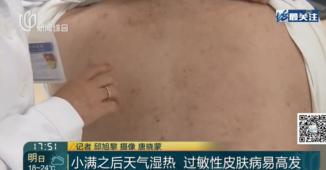 整晚睡不着! 沪一女子身上成片出现…近期高发,紧急提醒 整晚睡不着! 沪一女子身上成片出现…近期高发,紧急提醒