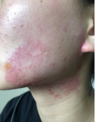 密密麻麻!杭州女子花重金美容却遭“毁容”!这种病最爱伪装 密密麻麻!杭州女子花重金美容却遭“毁容”!这种病最爱伪装