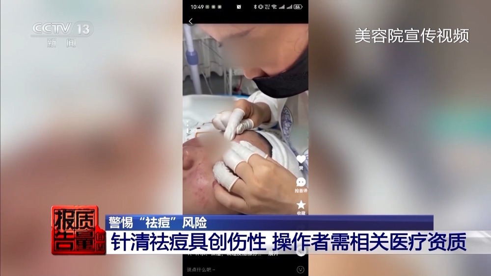 “针清”后痘痘不减反增 这些祛痘法操作不当可能会“烂脸” “针清”后痘痘不减反增 这些祛痘法操作不当可能会“烂脸”