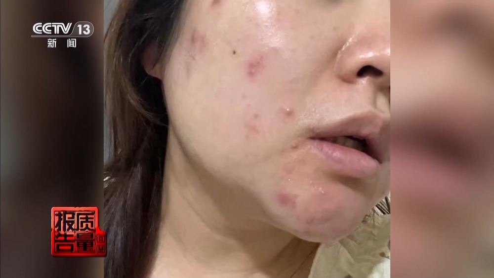 “针清”后痘痘不减反增 这些祛痘法操作不当可能会“烂脸” “针清”后痘痘不减反增 这些祛痘法操作不当可能会“烂脸”