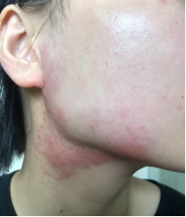 密密麻麻!杭州女子花重金美容却遭“毁容”!这种病最爱伪装 密密麻麻!杭州女子花重金美容却遭“毁容”!这种病最爱伪装