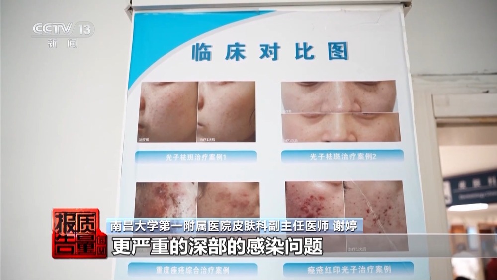 “针清”后痘痘不减反增 这些祛痘法操作不当可能会“烂脸” “针清”后痘痘不减反增 这些祛痘法操作不当可能会“烂脸”