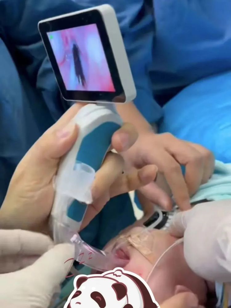 “趴睡宝宝”得救了!出生后只能“趴着睡”,医生为2月龄婴儿重建“生命气道” “趴睡宝宝”得救了!出生后只能“趴着睡”,医生为2月龄婴儿重建“生命气道”