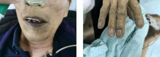 一碟下肚,中毒变“紫”了!这种家常小菜,很多人爱吃 一碟下肚,中毒变“紫”了!这种家常小菜,很多人爱吃