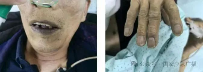 一碗下肚,男子变“紫”了!这道菜很多人爱吃…… 一碗下肚,男子变“紫”了!这道菜很多人爱吃……