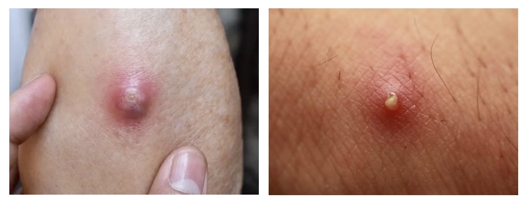 警惕！身上长了这种“小凸起”，千万别随便抠！