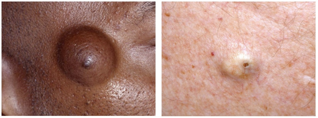 警惕！身上长了这种“小凸起”，千万别随便抠！