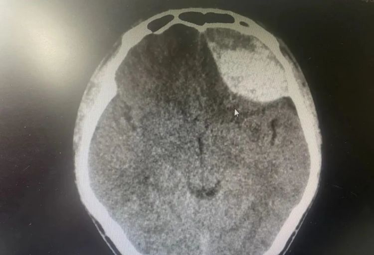 年仅22岁!小伙摔倒以为没事,7天后死亡! 年仅22岁!小伙摔倒以为没事,7天后死亡!