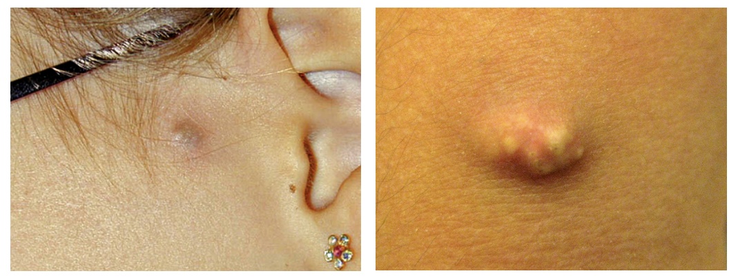 警惕！身上长了这种“小凸起”，千万别随便抠！