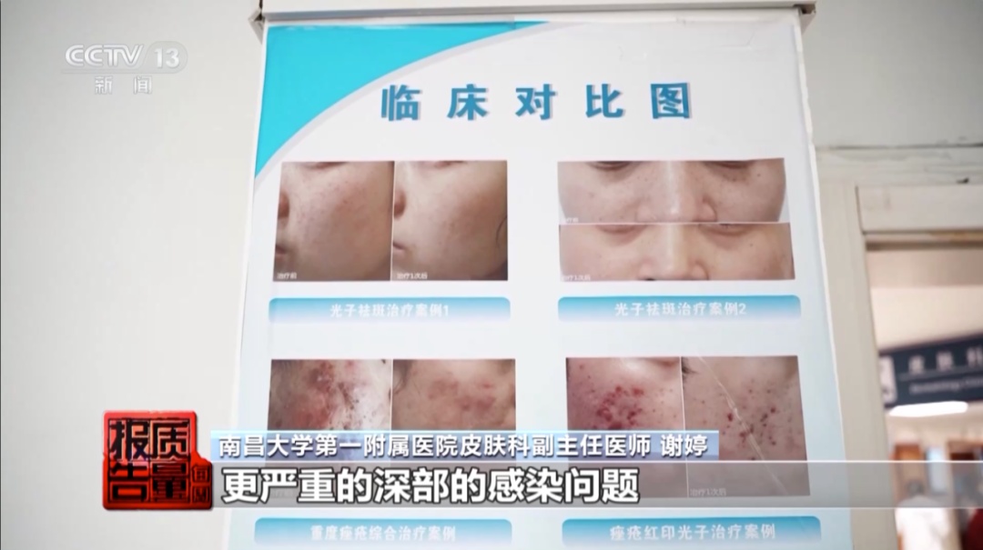 女子美容院祛痘,竟越祛越多!医生紧急提醒→ 女子美容院祛痘,竟越祛越多!医生紧急提醒→