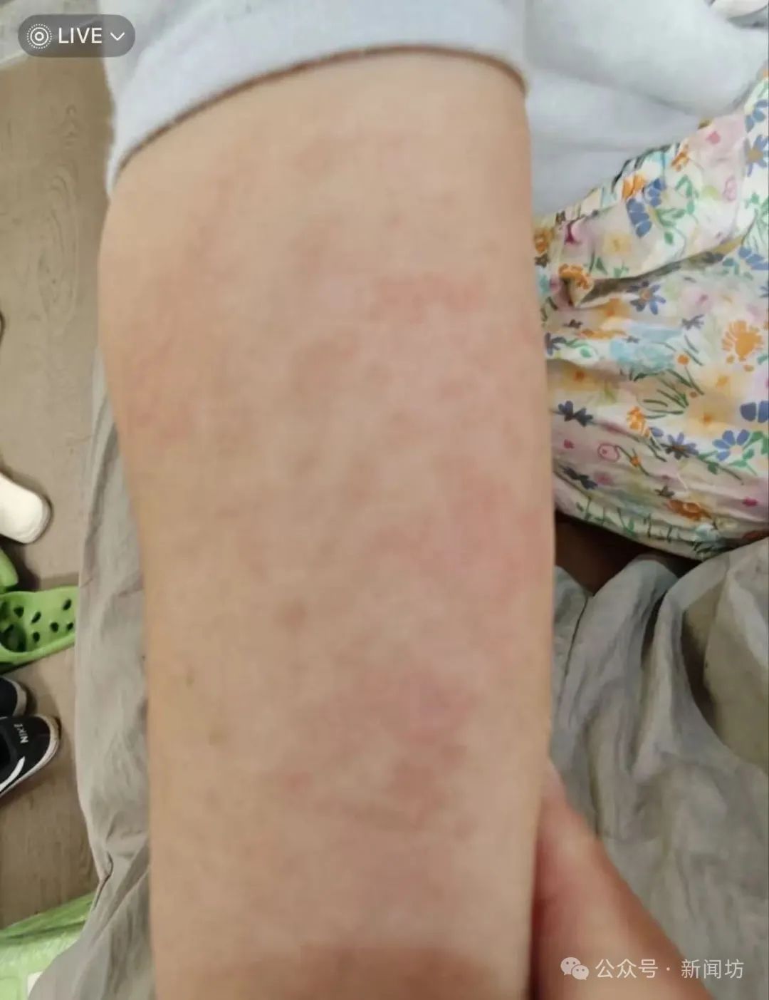 孩子摸了栏杆,回家后“手痒”去医院都清不干净……紧急提醒! 孩子摸了栏杆,回家后“手痒”去医院都清不干净……紧急提醒!