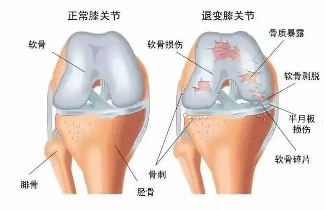 膝盖使用说明书:从今天开始“省着用” 膝盖使用说明书:从今天开始“省着用”