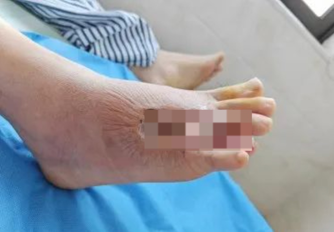 在沙发上睡了一觉,广东一男子差点截趾!严重或危及生命,近期千万当心 在沙发上睡了一觉,广东一男子差点截趾!严重或危及生命,近期千万当心