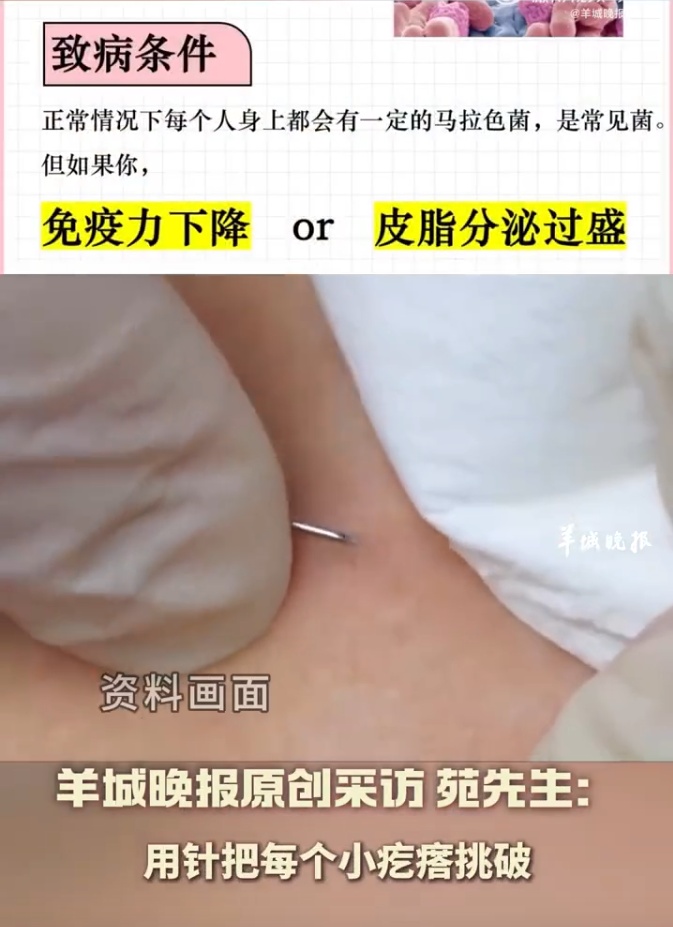 跑步出汗不及时擦干，男子感染真菌！“治疗时被疼哭…”