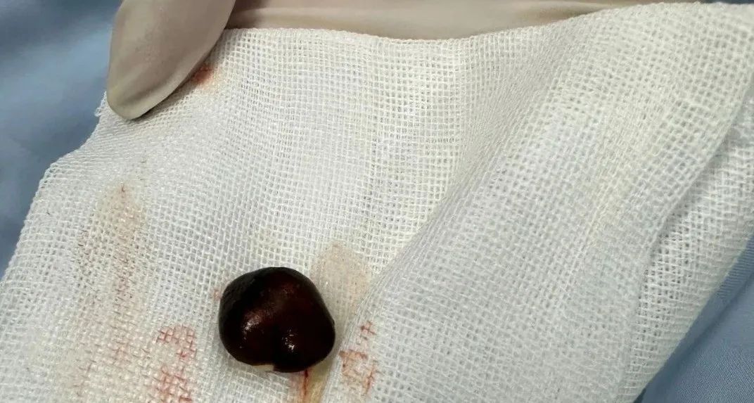 正大量上市！浙江有人吃它进了ICU，医生提醒：老人小孩尤其要当心……