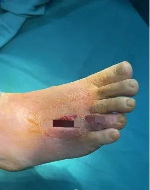 在沙发上睡了一觉,广东一男子差点截趾!严重或危及生命,近期千万当心 在沙发上睡了一觉,广东一男子差点截趾!严重或危及生命,近期千万当心