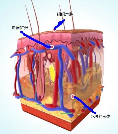 千万别忽视这“肿”!会遗传、可致命 千万别忽视这“肿”!会遗传、可致命