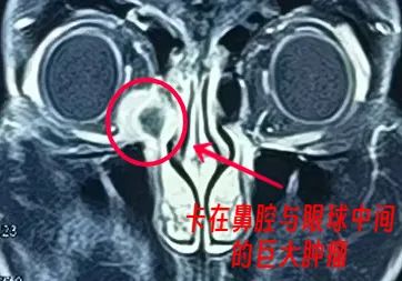 医生花6小时从眼里剥出颗“花生”！竟是瘤子长到泪囊里……