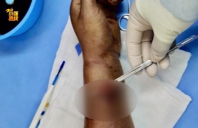 大动脉断了！男子拆快递拆进手术室，这个动作千万当心，很多人这样做…