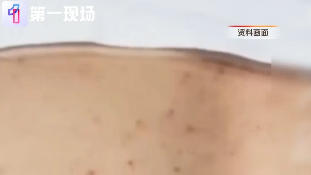 跑步出汗不及时擦干，男子感染真菌！“治疗时被疼哭…”