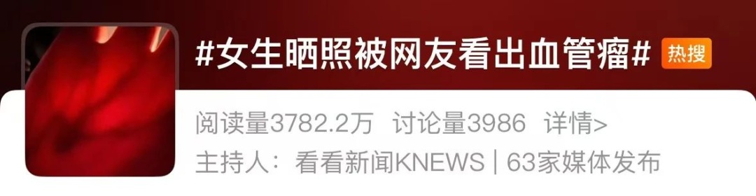 千万别抠！身上这种“红痣”可能是血管瘤