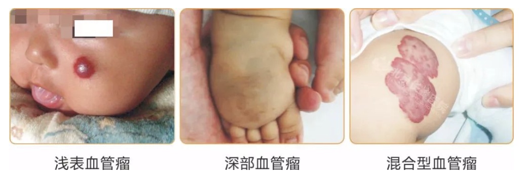 千万别抠！身上这种“红痣”可能是血管瘤