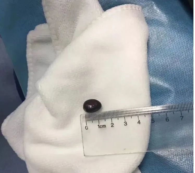 正大量上市！浙江有人吃它进了ICU，医生提醒：老人小孩尤其要当心……