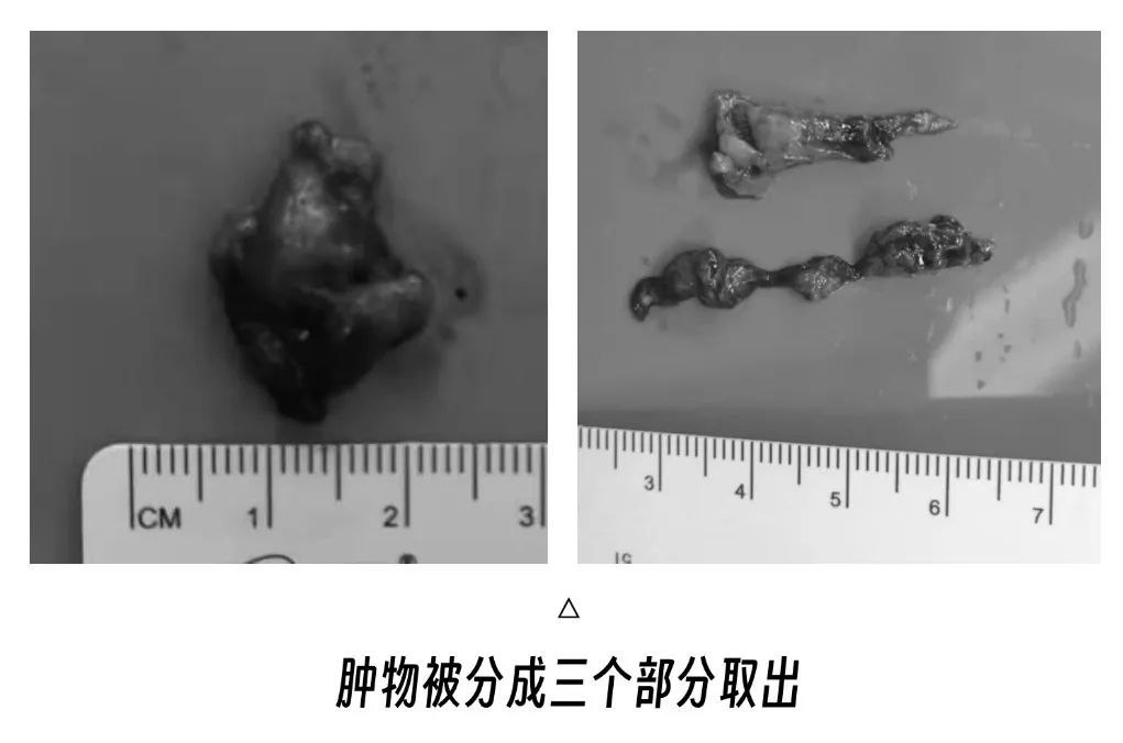 医生花6小时从眼里剥出颗“花生”！竟是瘤子长到泪囊里……