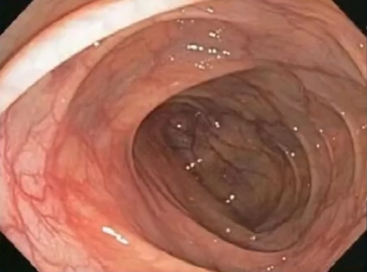 这种息肉可能会变成癌 排便出现4种异常建议及时就医 这种息肉可能会变成癌 排便出现4种异常建议及时就医