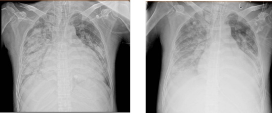 28岁小伙烧成“白肺”,去医院一查惊呆:“元凶”病毒竟然很常见 28岁小伙烧成“白肺”,去医院一查惊呆:“元凶”病毒竟然很常见