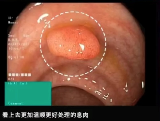 这种息肉可能会变成癌 排便出现4种异常建议及时就医 这种息肉可能会变成癌 排便出现4种异常建议及时就医