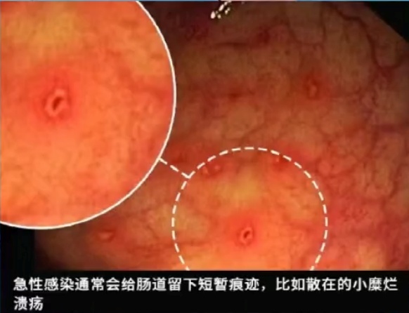 这种息肉可能会变成癌 排便出现4种异常建议及时就医 这种息肉可能会变成癌 排便出现4种异常建议及时就医