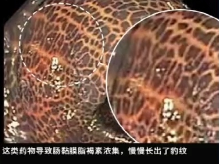 这种息肉可能会变成癌 排便出现4种异常建议及时就医 这种息肉可能会变成癌 排便出现4种异常建议及时就医